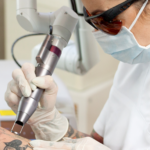 Tattooentfernung München – Effizient und hautschonend mit dem BiAxis QS Laser